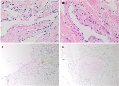 Embryonic Stem Cell-Like Subpopulations in Venous Malformation